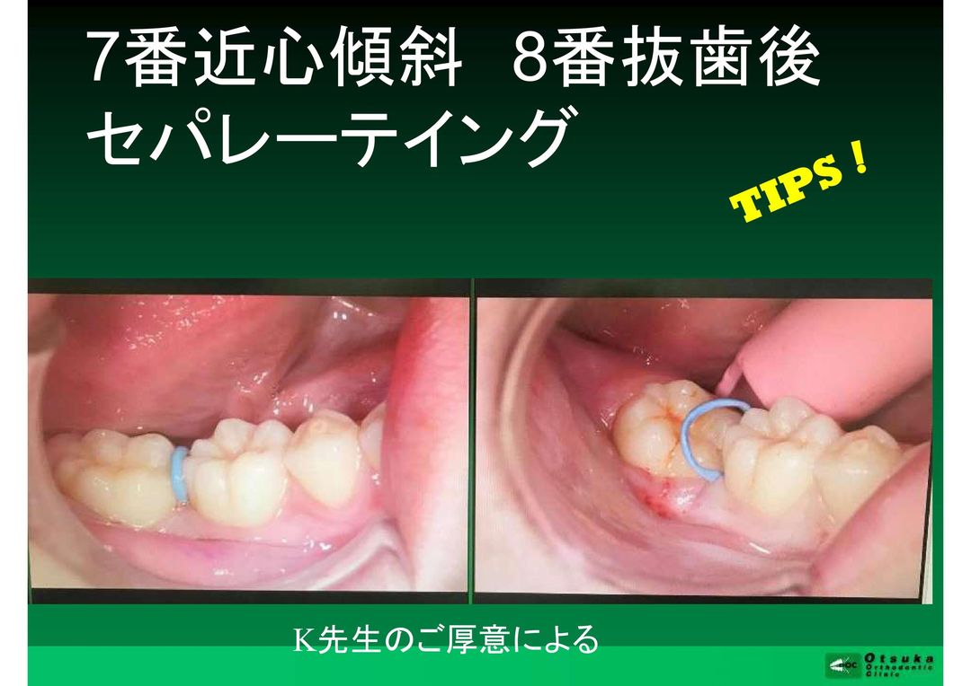 ①臨床のヒント ②プレオルソ 3月〜5月のセミナーのご案内です。｜公式・岡山市の矯正歯科「大塚矯正歯科クリニック」